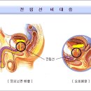 그놈의 전립선비대증 수술후기 이미지