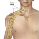 상완신경총 마비(brachial plexus injuries) 이미지