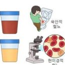 소변색깔 (오줌색깔 혈뇨,탁한,노란색) 이미지