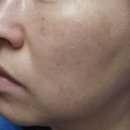 (주)패스쳐피아 | 인천구월동피부과에서 기미제거 받고 온 후기 효과 (feat.줌패스,피코슈어토닝,LDM)