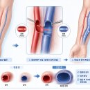 센텀도담외과의원 | 도담외과 동정맥루 수술, 혈액투석 전에 왜 필요할까요?