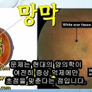 결막염 - 원인과 치료 방법 - 사암오행침, 사암침법, 오행침, 정통사암침 이미지