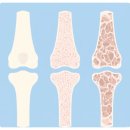 미사랑치과의원 | 아현역 치과, 골다공증 환자도 임플란트 할 수 있나요?