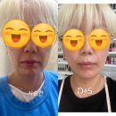 압구정미라클의원 | 압구정 미라클의원 박종현 원장님께 퀼실리프팅 받은 후기