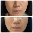 분당톡스앤필의원 | 일산 주엽톡스앤필 원더트리플 리프팅 일주일 후기~