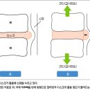 허리디스크의 비수술적 치료 이미지