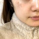 희망약국 | 약국 멜라토닝크림 기미 여드름 해결 세럼 후기