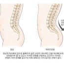 척추전만증 lordosis[요추전만증] 이미지