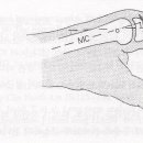 수지부의 골절과 탈구의 치료원칙 이미지