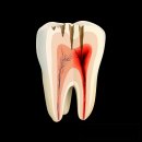 플란트앤와이필치과의원 | 부평시장역치과 충치 임플란트 발치 후 식립 진행한 케이스