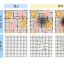 황반변성 증상 원인 예방 치료 방법 이미지