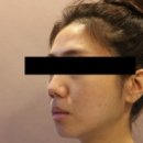 루다통상 | 신사역 얼굴자가지방이식 전후 후기, 붓기와 유지기간 알려드려요