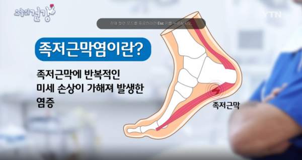 족저 근막염 신발 수술 치료법 5가지