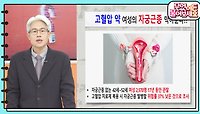 [핫뉴스 브리핑] 고혈압 약, 여성의 자궁근종 막아준다?! | KBS 240426 방송 