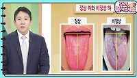 [무엇이든 팩트체크] 갑자기 혀가 꼬이는 건 뇌졸중의 전조다? 혀로 알아보는 건강 적신호🚨 | KBS 240517 방송 